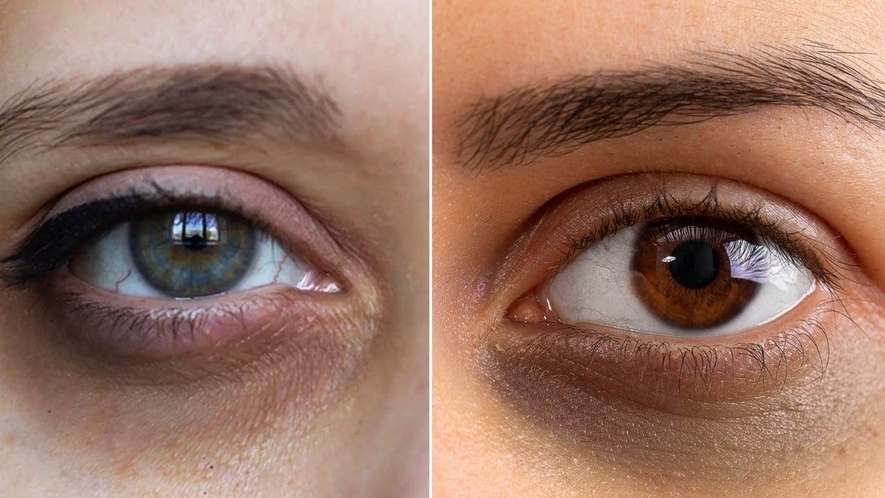 आप भी आंखों के नीचे काले धब्बे से है परेशान, यह 7 नुस्खे आपके लिए होंगे रामबाण साबित आप भी आंखों के नीचे काले धब्बे से है परेशान, यह 7 नुस्खे आपके लिए होंगे रामबाण साबित